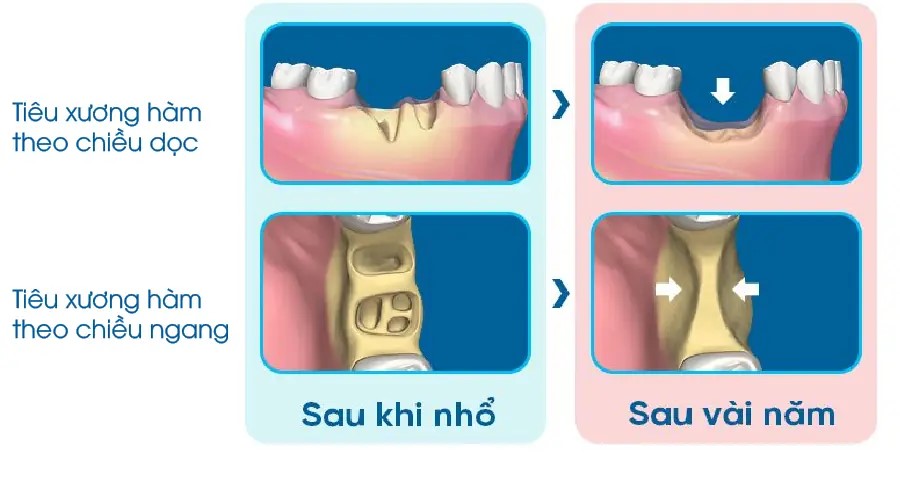 tieu-xuong-rang-va-giai-phap