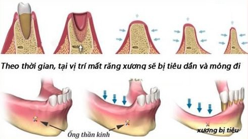 dau-hieu-nhan-biet-tieu-xuong-rang