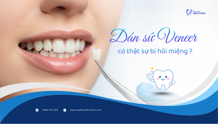 dan-su-veneer-bi-hoi-mieng