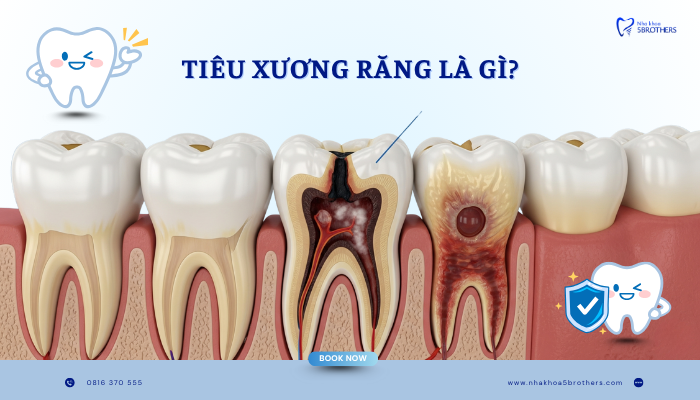 tieu-xuong-rang-la-gi